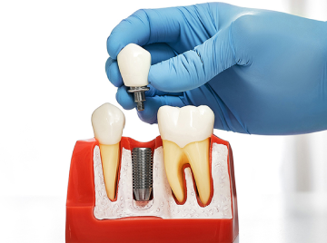 What Should You Avoid After Getting Dental Implants?