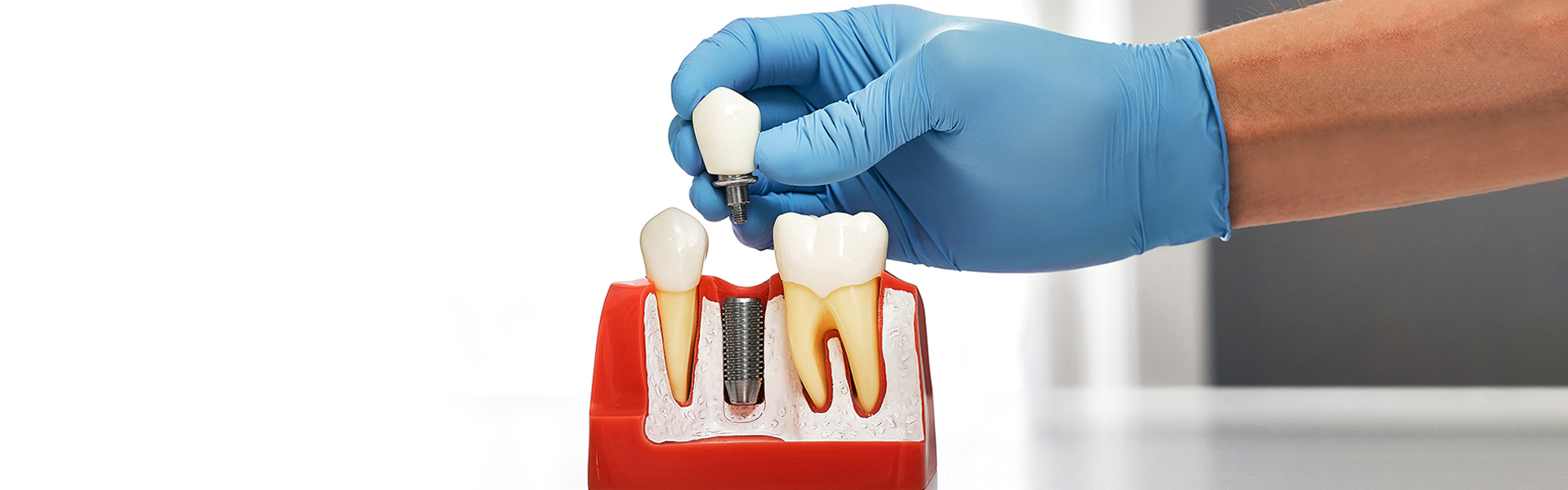 Dental Implants