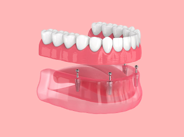 What Are the Long-Term Benefits of Dental Implants?