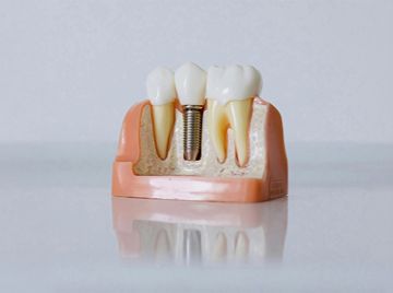 How to Choose the Right Implant Dentist in Brampton